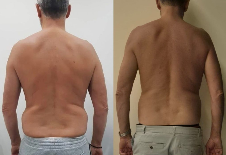 Fat Freezing in Hertfordshire | body sculpting company ware gallery image 11