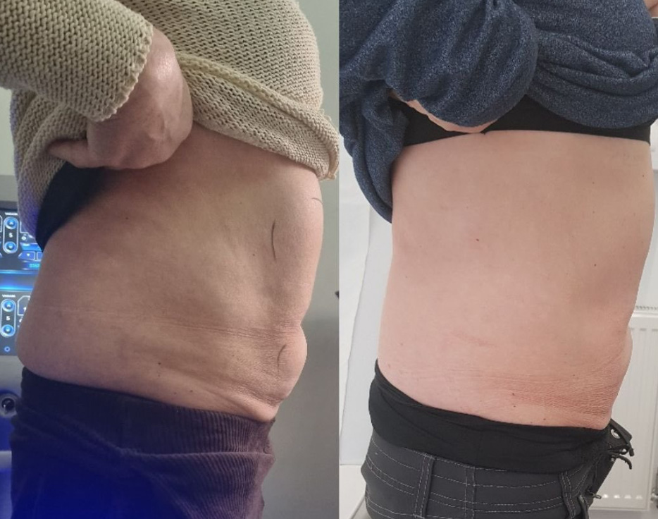 Fat Freezing in Hertfordshire | body sculpting company ware gallery image 12