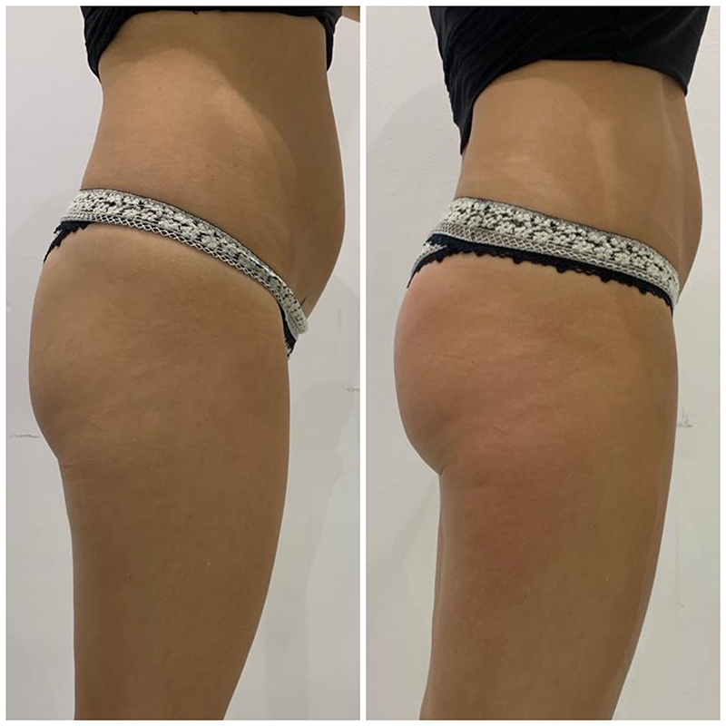 Fat Freezing in Hertfordshire | body sculpting company ware gallery image 16