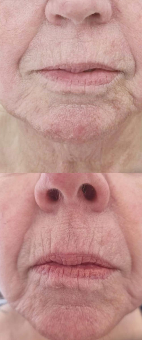 RF Skin tightening before and after
