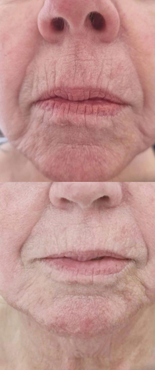 RF Skin tightening before and after