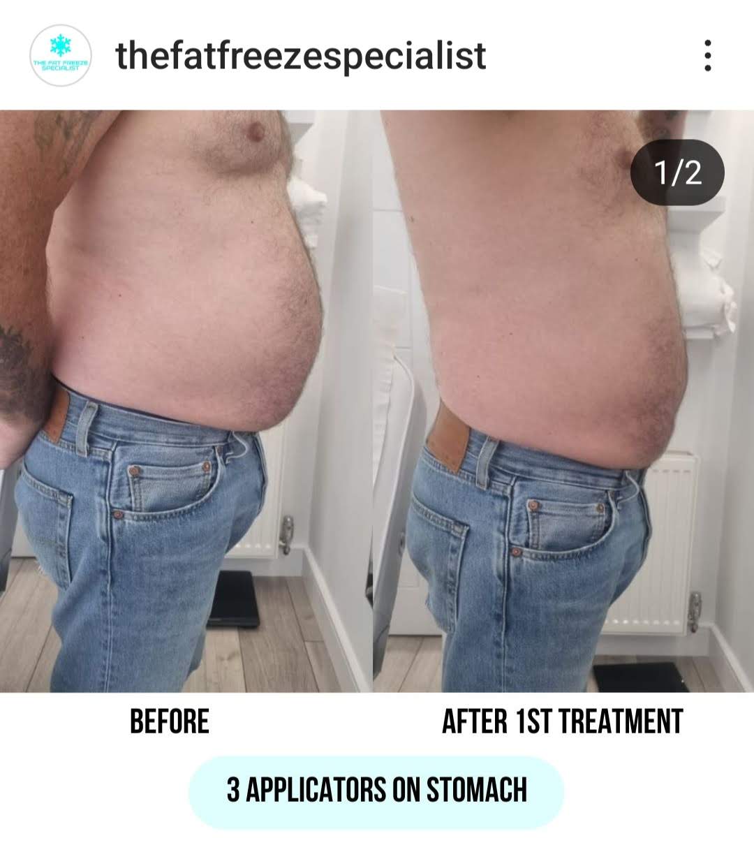 Fat Freezing in Hertfordshire | body sculpting company ware gallery image 8
