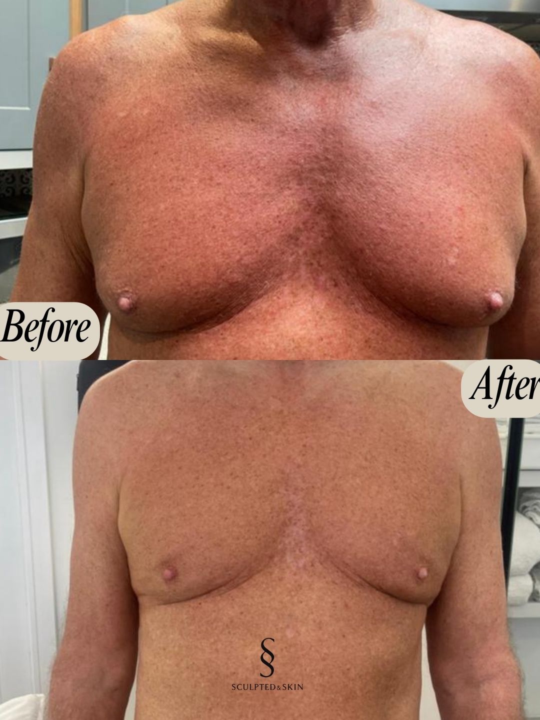 Fat Freezing in Hertfordshire | body sculpting company ware gallery image 6