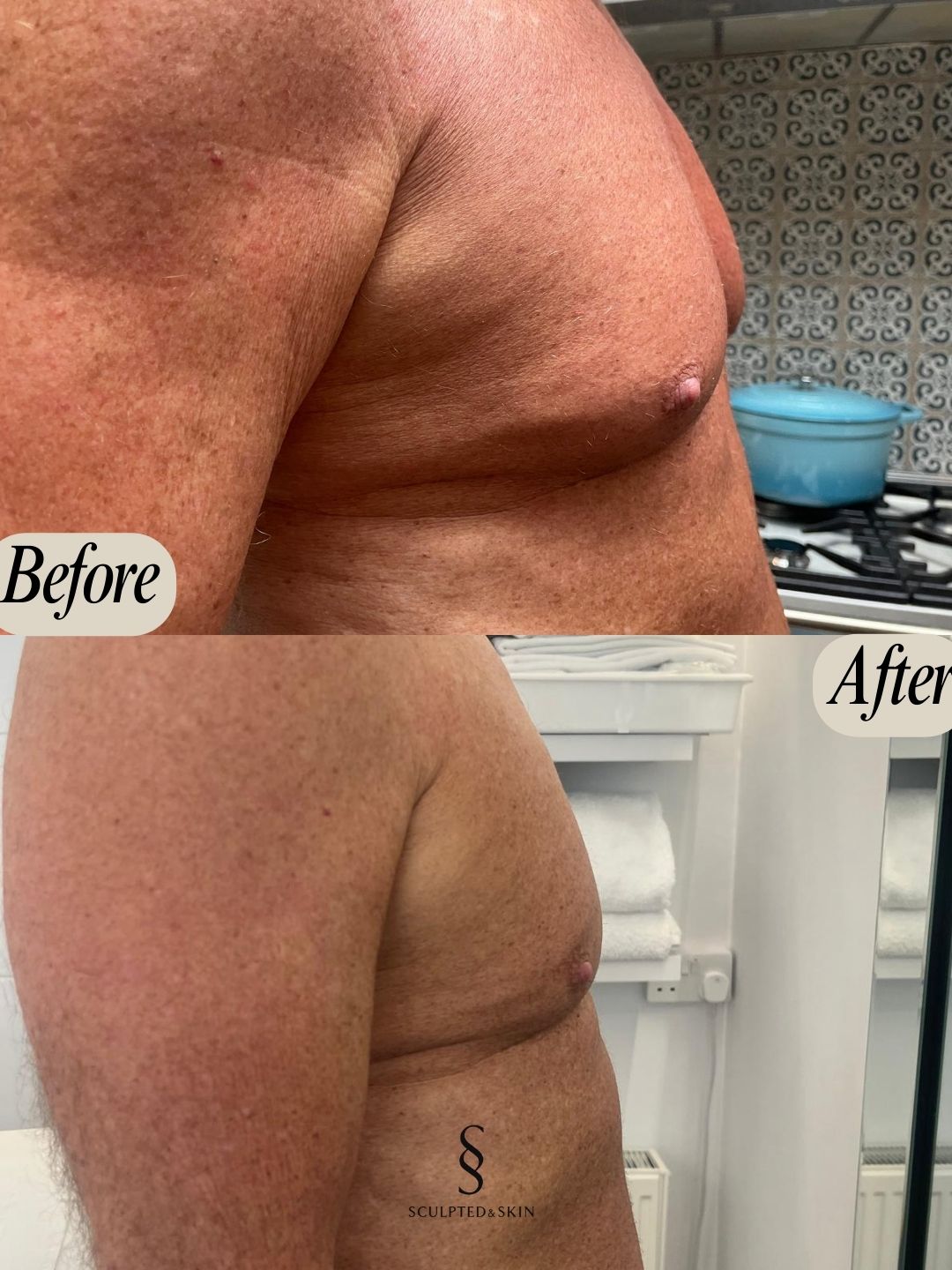 Fat Freezing in Hertfordshire | body sculpting company ware gallery image 7