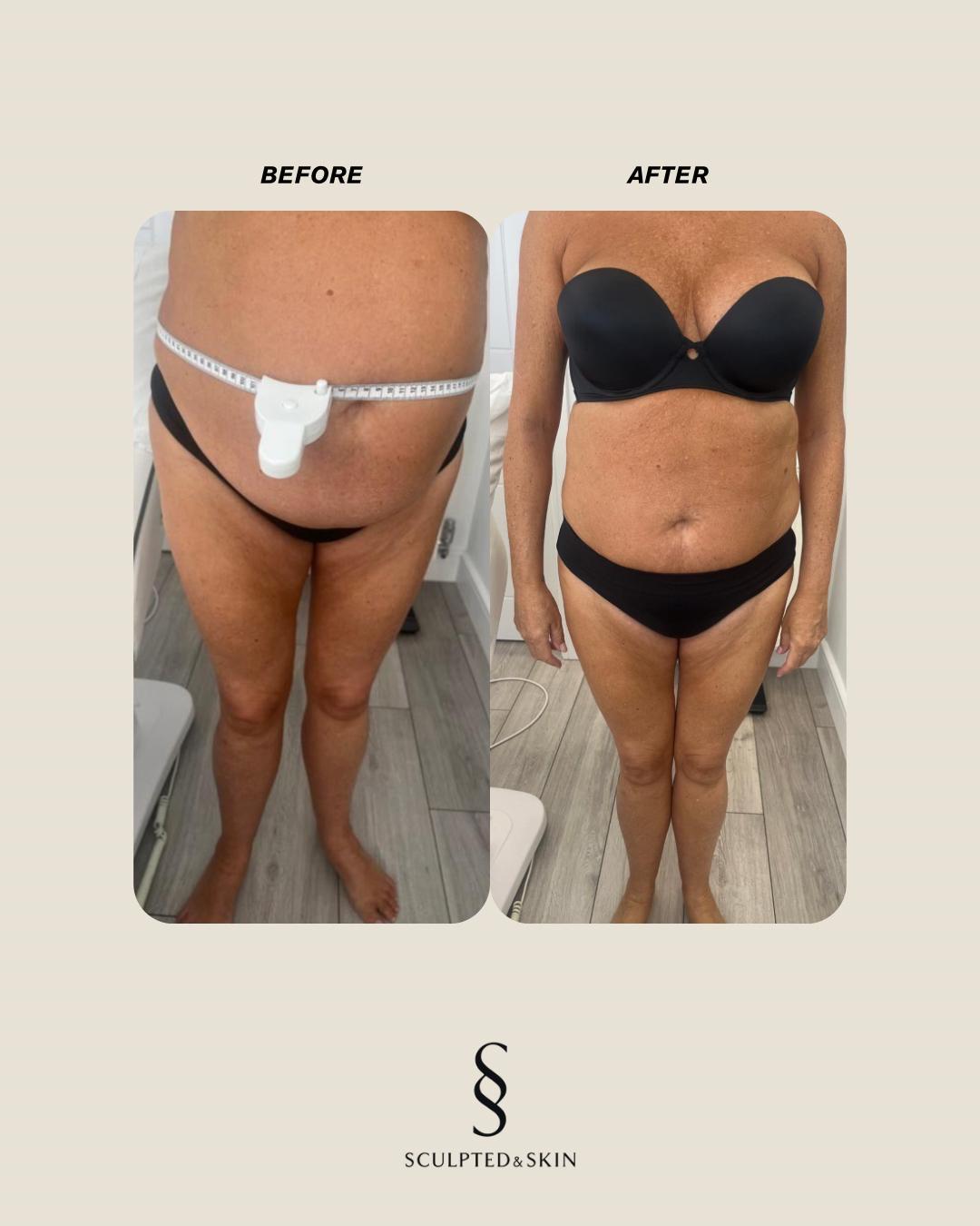 Fat Freezing in Hertfordshire | body sculpting company ware gallery image 1