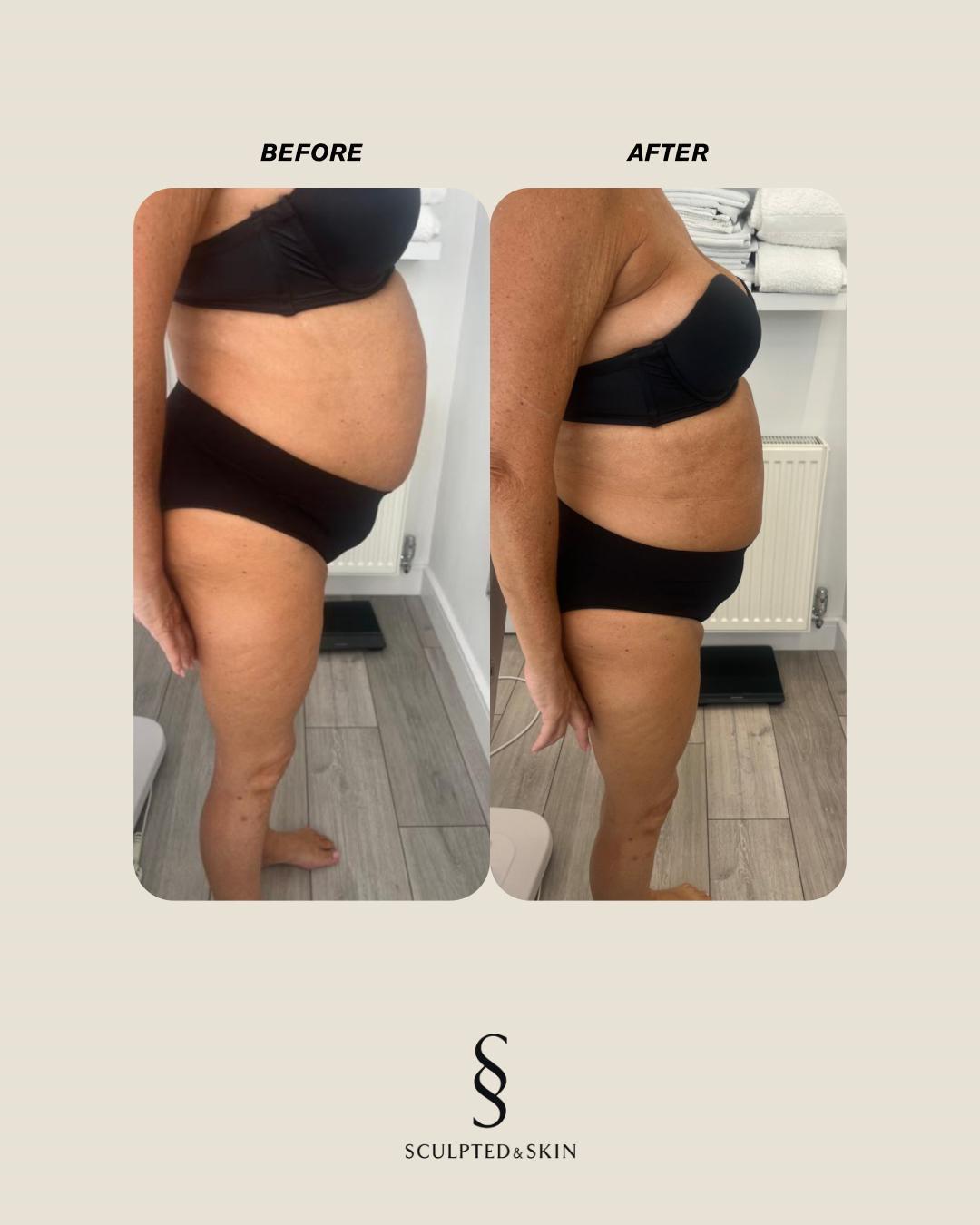 Fat Freezing in Hertfordshire | body sculpting company ware gallery image 2