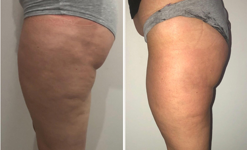 Fat Freezing in Hertfordshire | body sculpting company ware gallery image 14