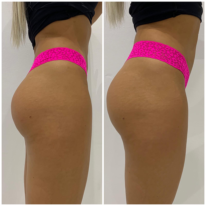 Fat Freezing in Hertfordshire | body sculpting company ware gallery image 15