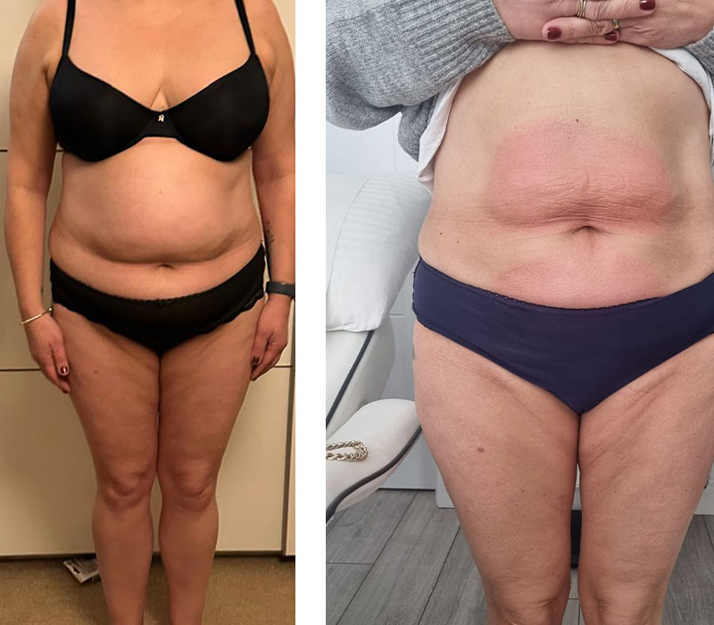 woman in black and navy underwear showing abdomen differences before and after treatment results 2 stages of transformation