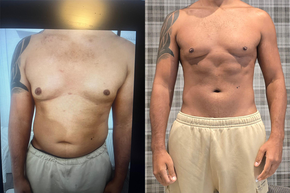 Fat Freezing in Hertfordshire | body sculpting company ware gallery image 9
