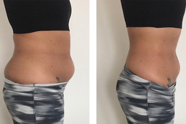 Tummy sculpt before and after