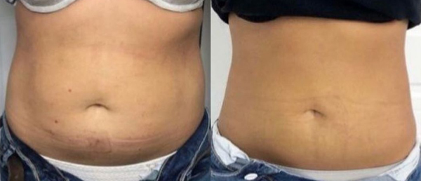 Fat Freezing in Hertfordshire | body sculpting company ware gallery image 17