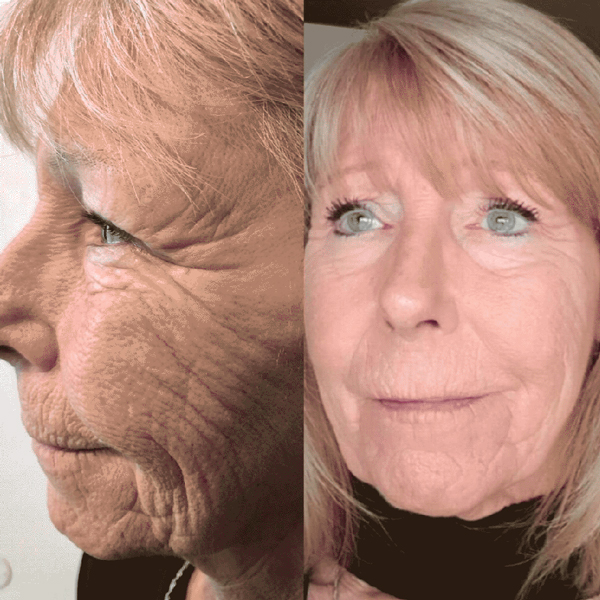 Fat Freezing in Hertfordshire | body sculpting company ware gallery image 3