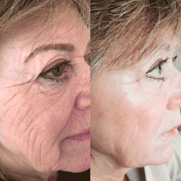 Fat Freezing in Hertfordshire | body sculpting company ware gallery image 5