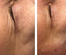 before and after image of a thigh showing changes in skin texture and appearance with noticeable improvement in the contour representing effective results in seven steps to enhance skin health