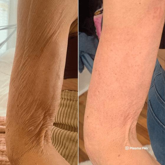 before and after comparison of arm skin texture showing improvement in firmness and reduction of wrinkles with skin treatment advantages for anti-aging solutions