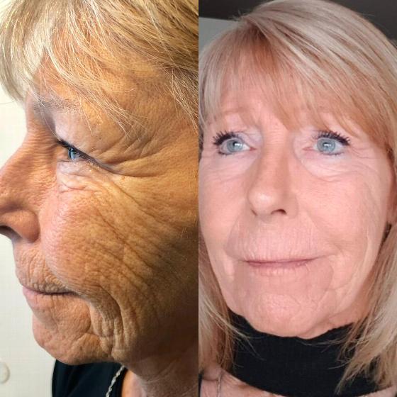 before and after image showing skin texture improvement with reduced wrinkles on an older woman's face highlighting anti-aging treatment results 3 effective solutions 3 benefits 3 stages