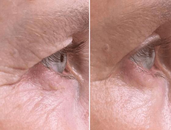 before and after images showing abdominal skin with visible stretch marks and changes in texture related to weight changes or pregnancy discussed in 10 tips for skin health