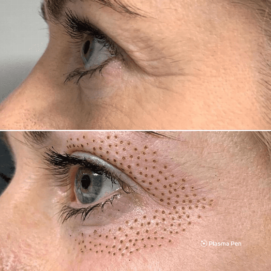 Before and after images of eye area treatment showing visible changes in skin texture and tightness with treatment results from plasma pen procedure for youthful appearance.