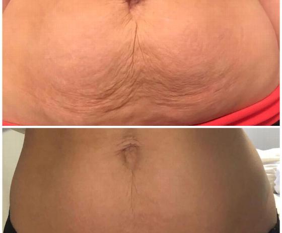 side view of a woman showing before and after weight loss transformation highlighting the difference in belly outline demonstrating effective results through a 5 step program