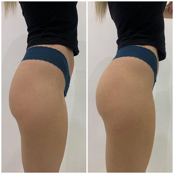side-by-side comparison of a woman's buttocks showing two different views in lace thong underwear demonstrating body contouring results