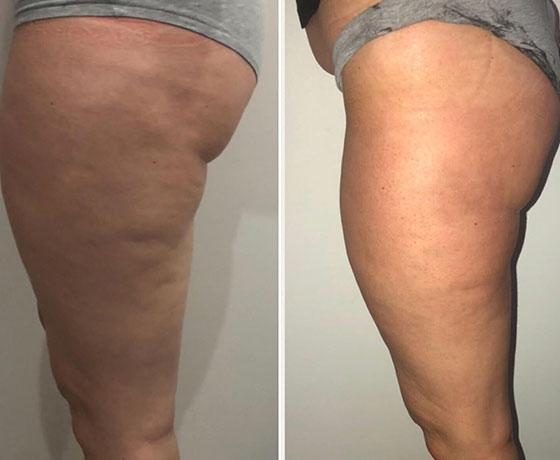 body sculpting company in ware and hertfordshire