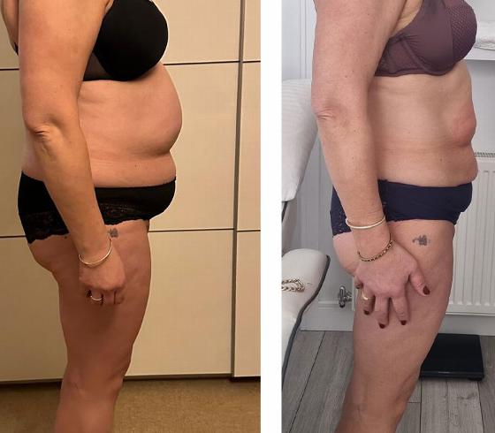 side view of woman before and after body transformation showing changes in stomach and hips with noticeable slimming and improved contour reflecting progress in fitness and health journey 3 steps ahead