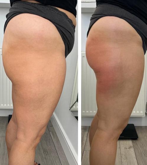 side-by-side comparison of two thighs showing differences in skin tone and texture demonstrating results from beauty treatment or procedure beneficial for aesthetic purposes 4 ways to enhance skin quality