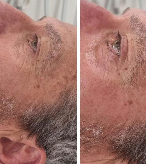 close-up of a man's face showing before and after cosmetic treatment emphasizing rejuvenation and improved appearance for youthful skin 2 different views