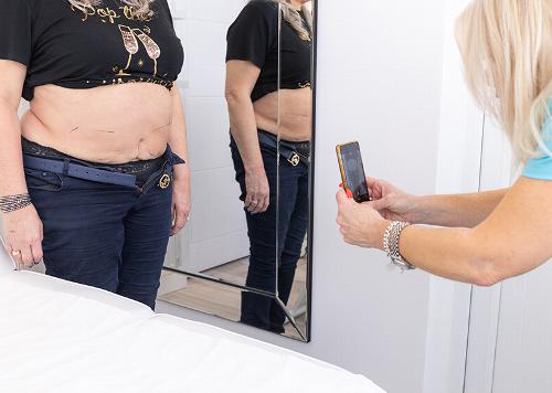 person showing side profile revealing skin with noticeable stretch marks in a clinical setting promoting skin health and treatment