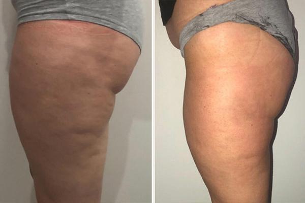body sculpting company in ware and hertfordshire