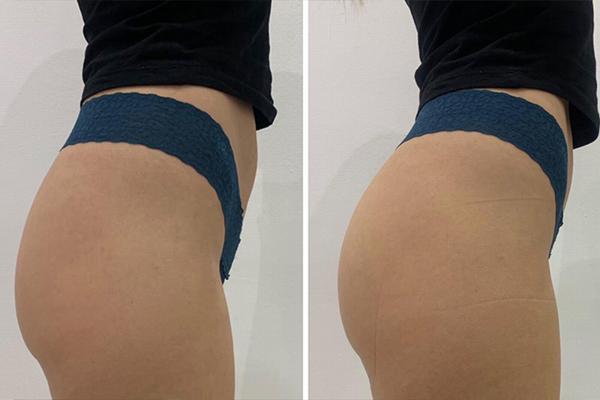 body sculpting company in ware and hertfordshire